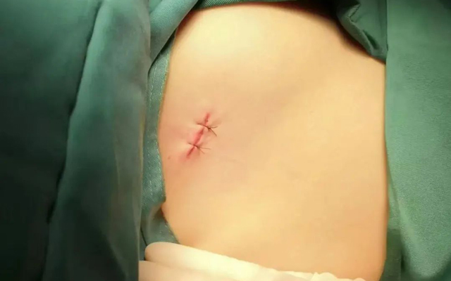 来凤县人民医院：气胸很“凶”，青少年需警惕