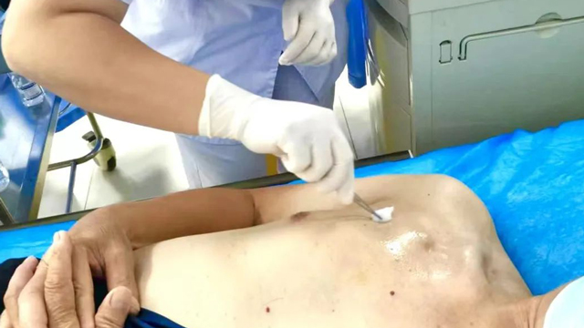 来凤县人民医院可以做输液港维护哦，来聊聊植入式输液港二三事