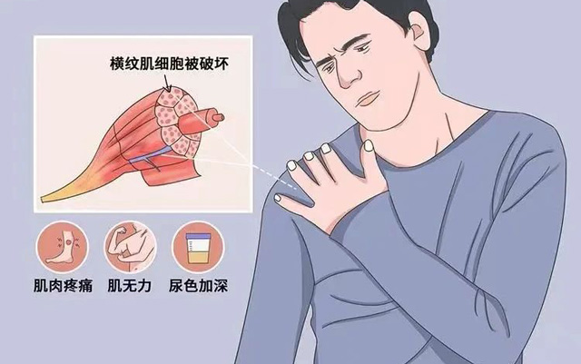 运动不要太疯狂！ 警惕横纹肌溶解症