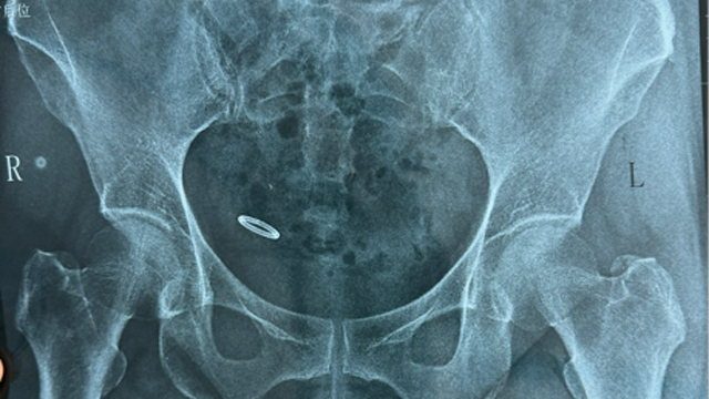 腹腔镜下成功取出“离奇失踪”节育器