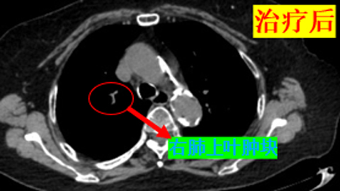 【省肿瘤医院专家帮扶我院动态】83岁小细胞肺癌患者化疗获显著疗效！