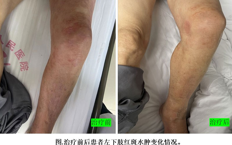 【省肿瘤医院专家帮扶我院动态】团队协作！多学科会诊治疗晚期肺癌并发症