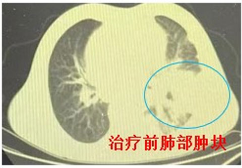 【省肿瘤医院专家帮扶我院动态】免疫治疗点燃希望