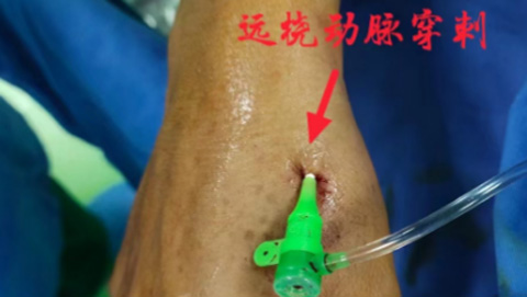 县域首例!县人民医院成功通过远桡动脉逆向开通闭塞桡动脉