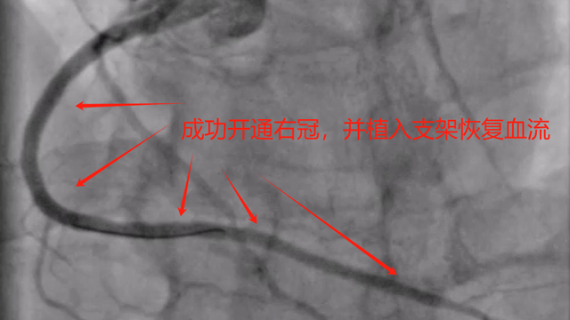 来凤县人民医院：再次成功开通CTO血管病变联合IVUS精准治疗