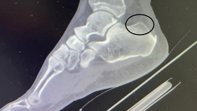 小切口巧除病痛 关节镜给“足”关“踝”