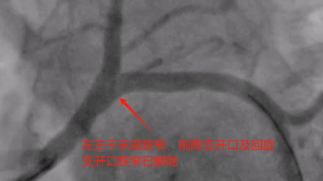 生命至上，县人民医院再次为85岁患者成功开展高难度左主干分叉病变手术