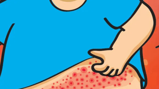 带状疱疹？接种疫苗可预防！