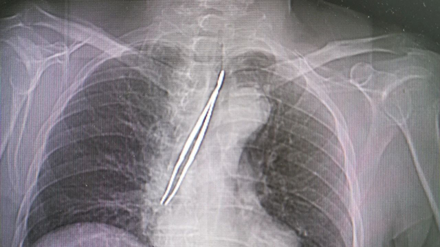 “物”入“气”途，“医”探究“镜”——气切护理莫大意