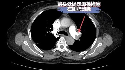 县人民医院成功救治多例高危肺栓塞患者