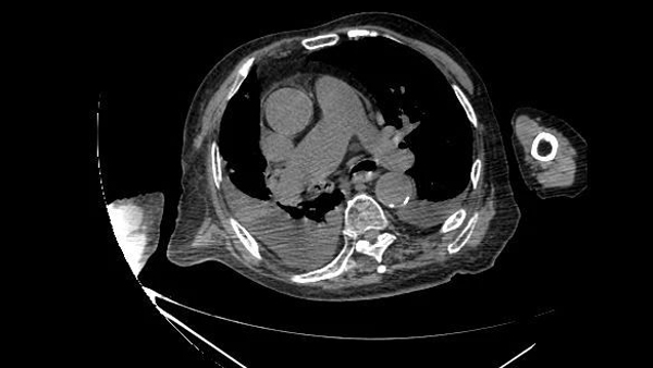 气管镜介入救百岁老翁于危难之中