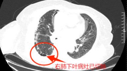 经皮肺穿刺技术：精准诊断，为健康护航