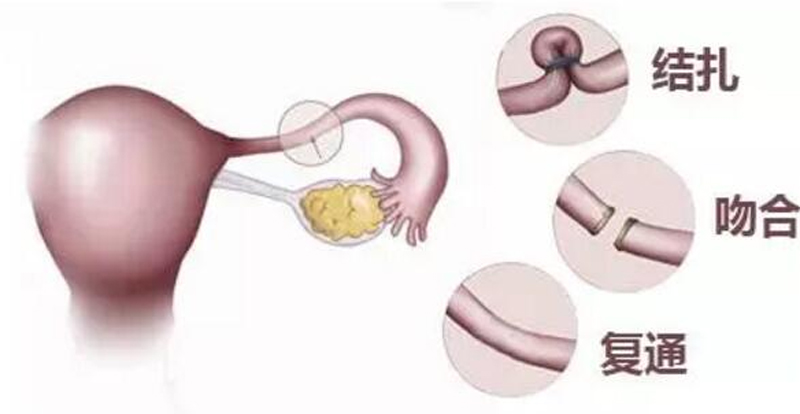 成功实施输卵管复通术，帮助患者实现自然受孕