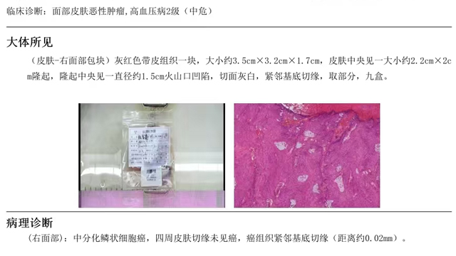 62岁患者在来凤县人民医院重获 “颜面”